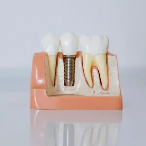 All Inclusive Dental Implant Treatment